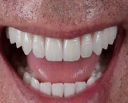 after all-on-four dental implants