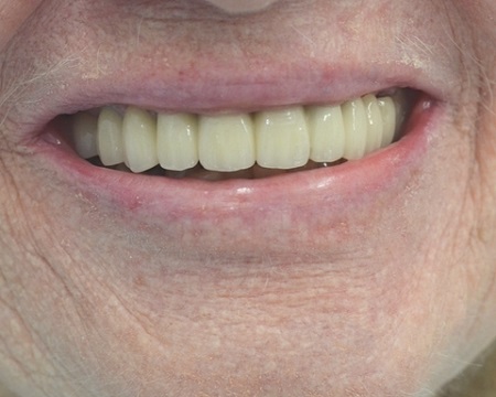 after all-on-four dental implants antalya