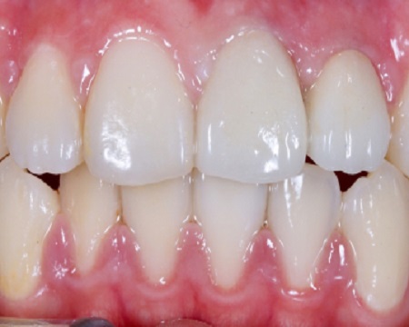 After Dental Crowns