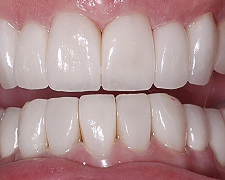 After Dental Crowns Turkey