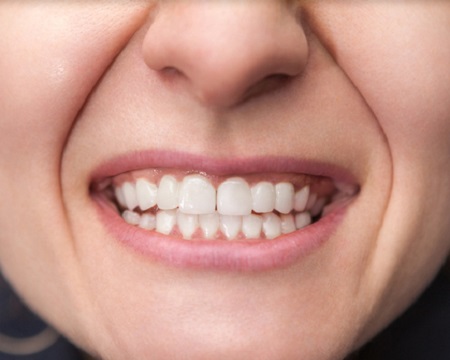 after dental implants