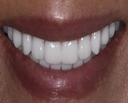 after dental implants antalya