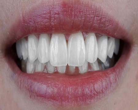 After Dental Veneers