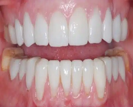 After Dental Veneers Turkey