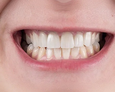 After Dental Veneers Antalya