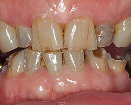 Before Dental Crowns Turkey