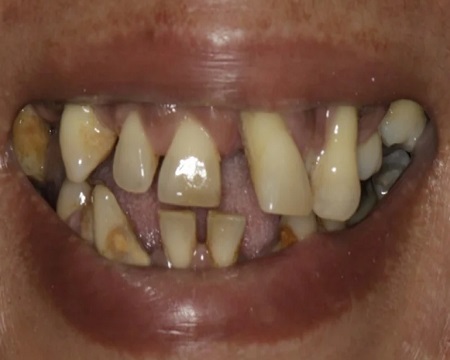 before dental implants antalya