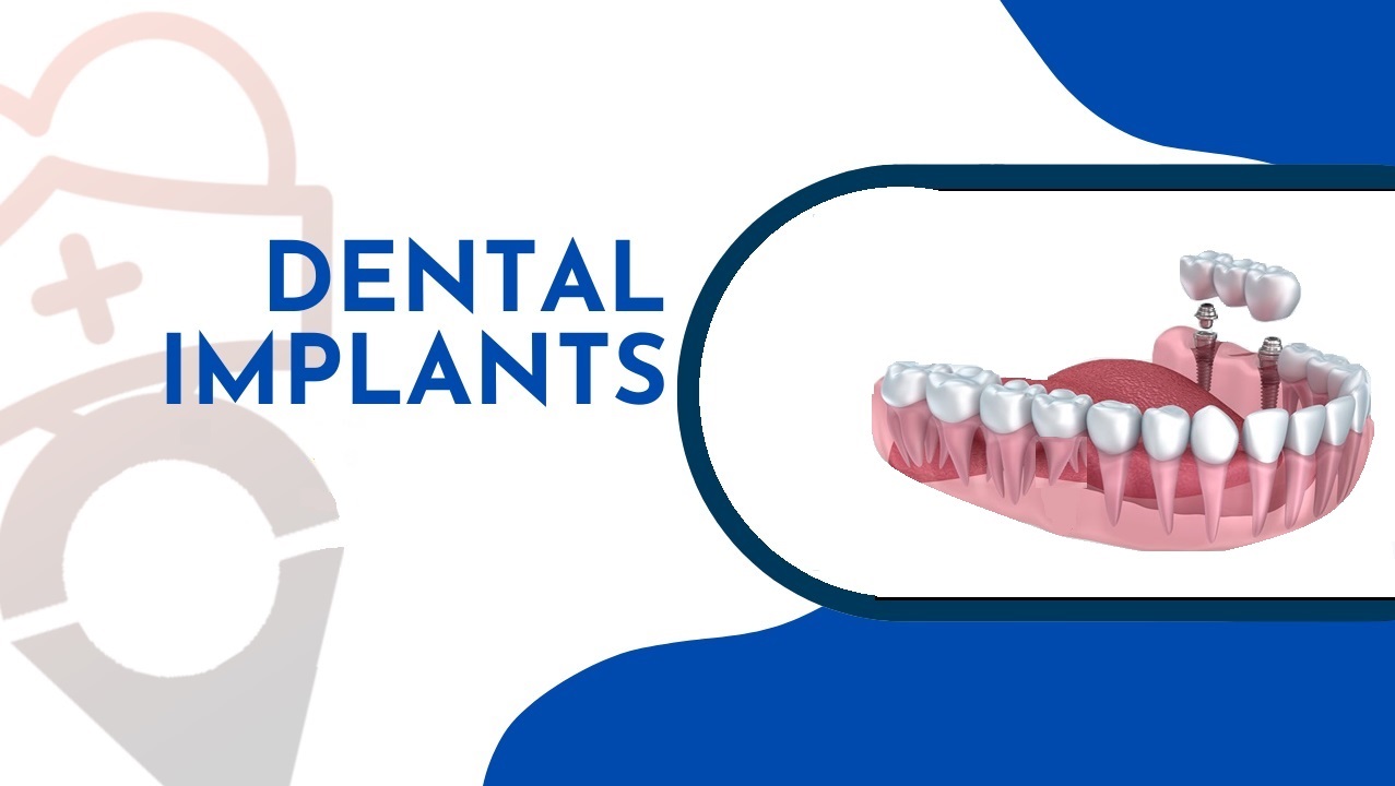 Dental Implants in Turkey, Which New Technologies Used Dental Implants in Turkey?