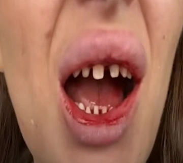 bad turkey teeth