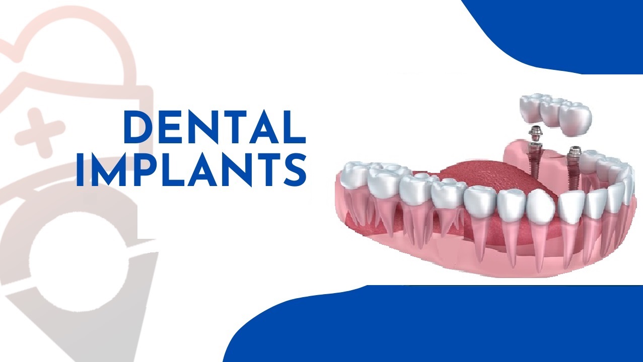 Dental Implants in Turkey