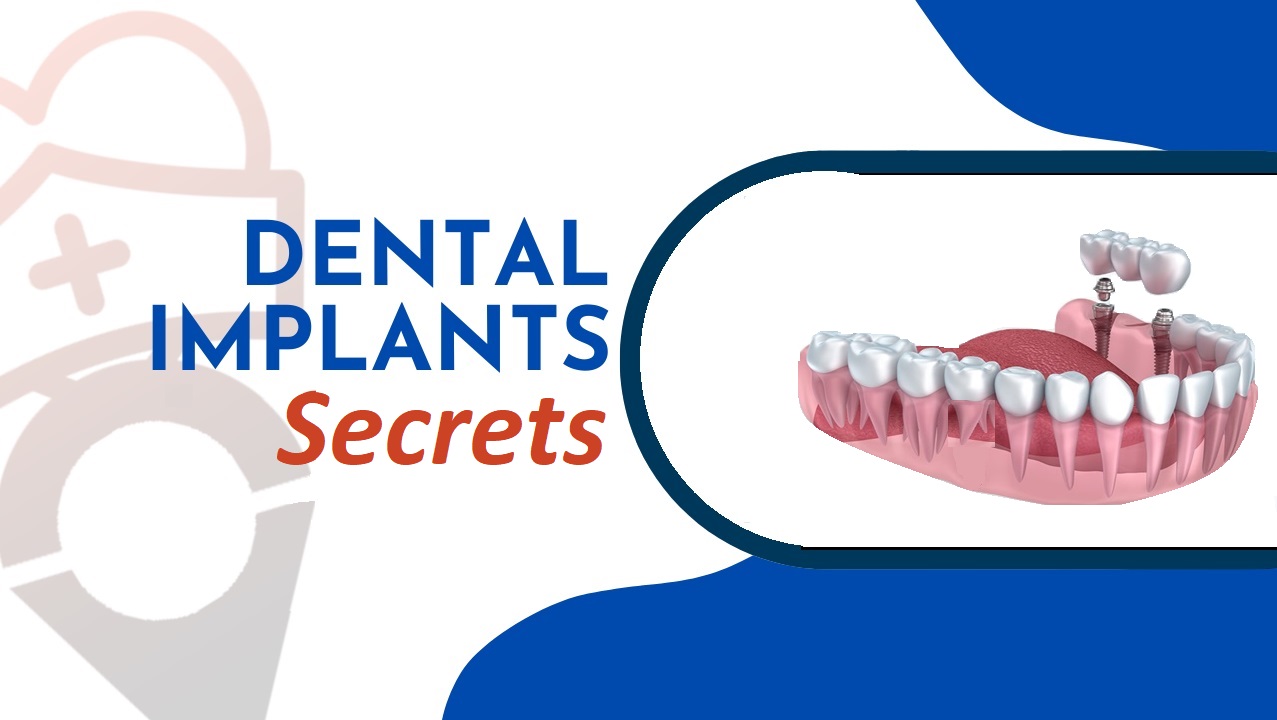 Implant Secrets