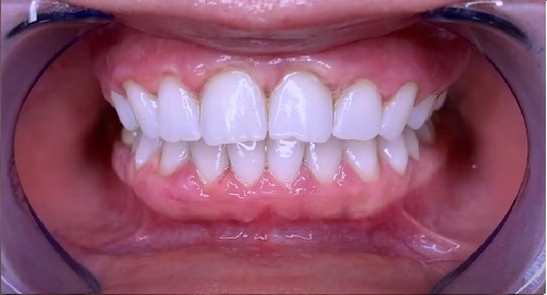 Teeth Whitening After