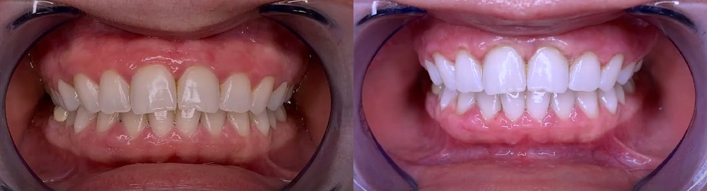  Teeth whitening before after turkey