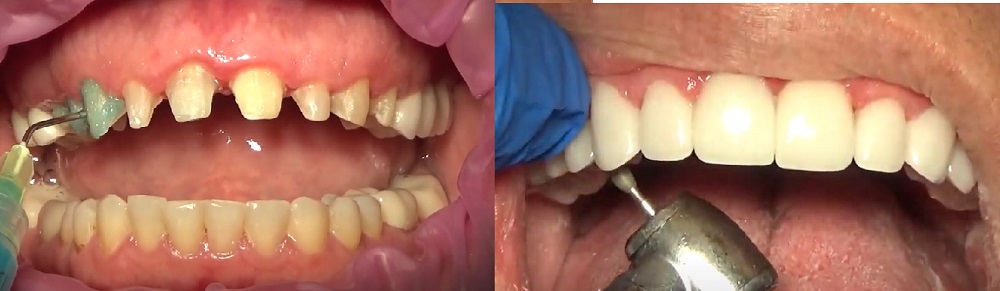 Turkey Teeth before and after 