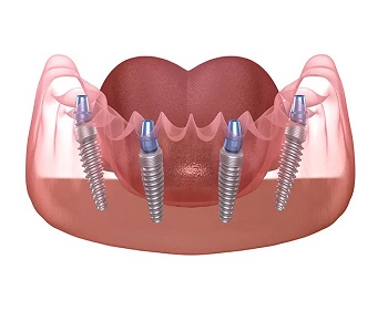 All on 4 Dental Implants Antalya