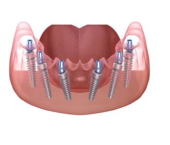 All on 6 dental implants turkey