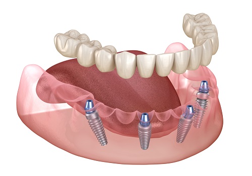 All on 4 Implant Package Deal