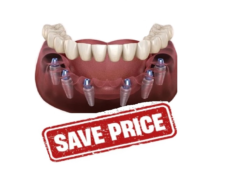 All on 6 Dental Implants Turkey Price