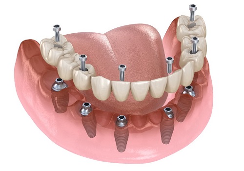 All on 6 Implant Packages