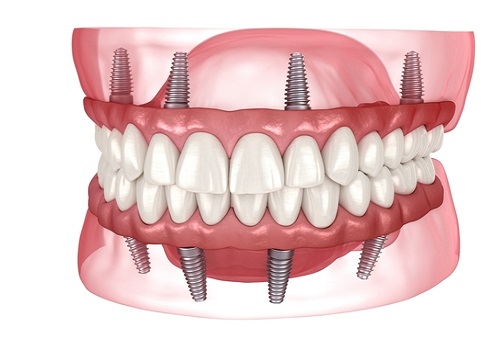 Full Mouth Implant Package Deals