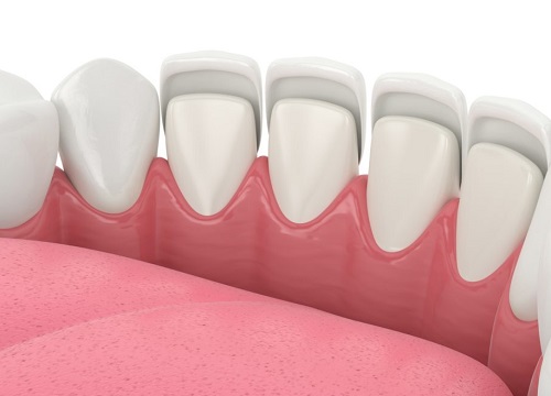 Emax Teeth Veneers package