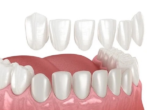 Empress Teeth Veneers package