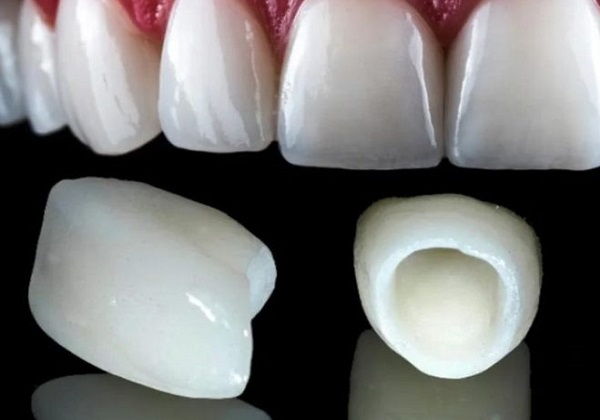 Full Mouth Implant Package Deals