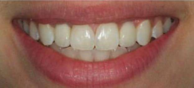 After Dental implants turkey healthy teeth patient