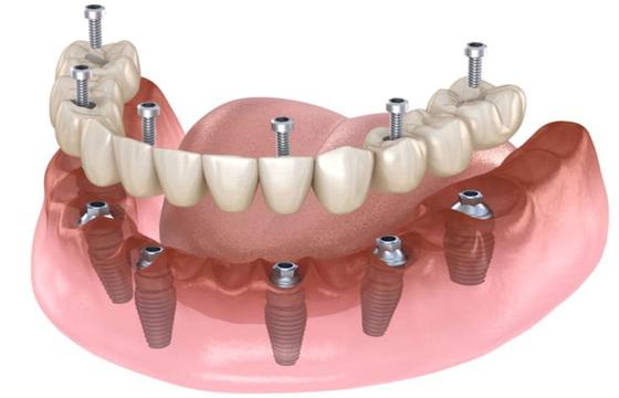 All on 6 Dental Implants