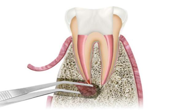 Apical Resection