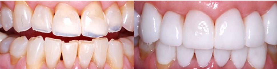 Before After Porcelain dental veneers turkey