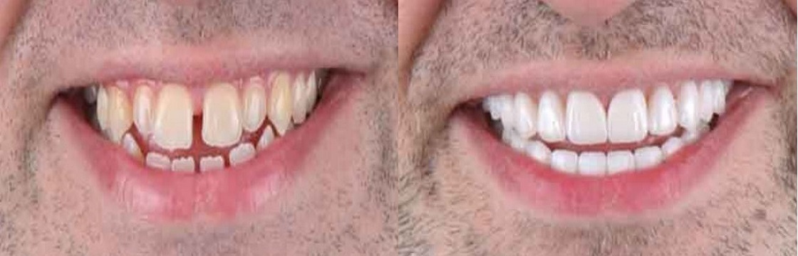 Before After dental veneers turkey