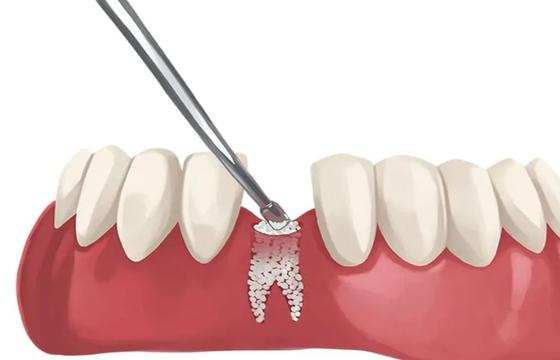 Bone Grafting