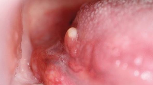 Dental Cyst and Tumors