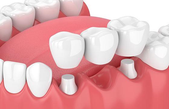 Dental Bridges