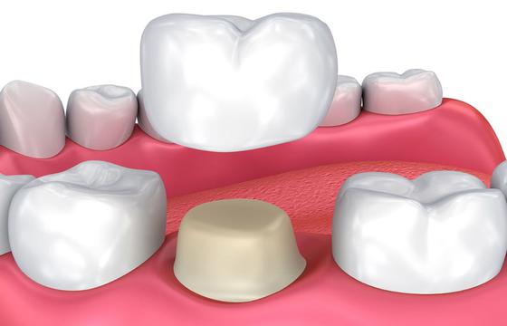 Dental Crowns