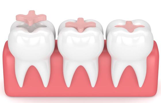 Dental Fillings