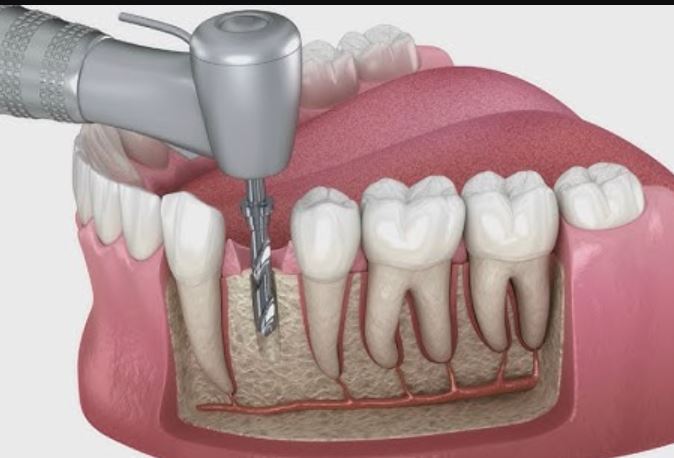 Dental Implants Video Thumbnail