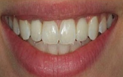 Teeth Implants After