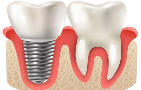 Dental Implants