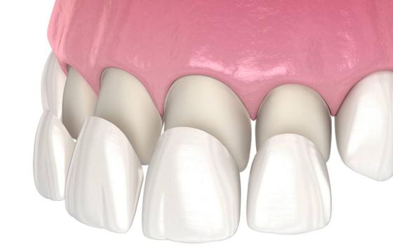 Turkey Teeth Veneers 