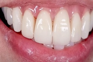 E-Max Veneers After