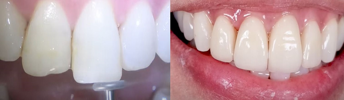 Emax Before After veneers 