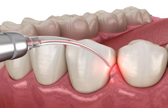 Gum Disease Treatment