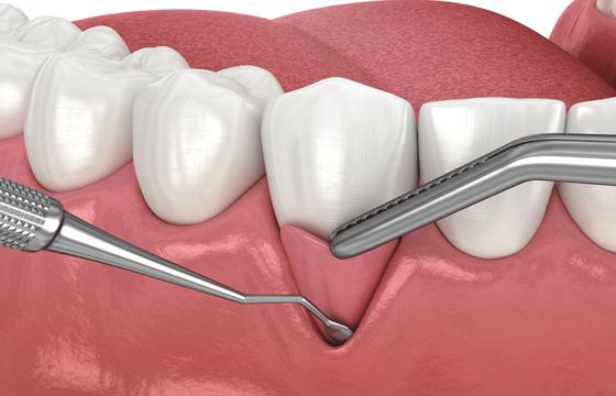 Gum Graft Surgery