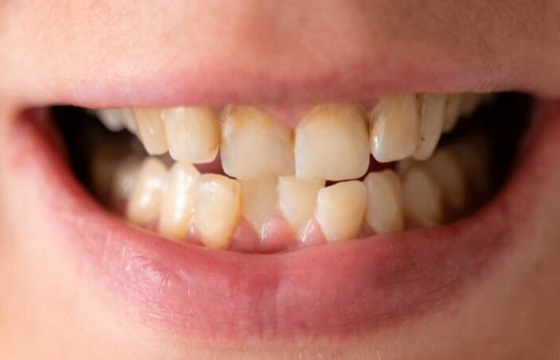 Misaligned Teeth