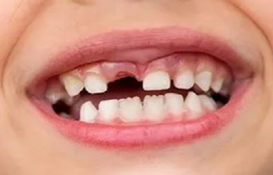 Tooth Loss, Missing Teeth