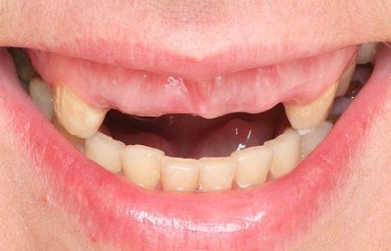 Multiple Tooth Loss, Multiple Missing Teeth