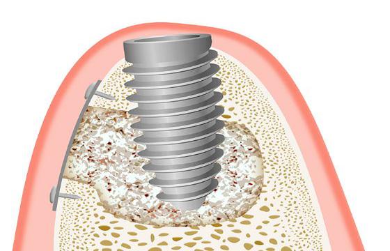 Osseointegration