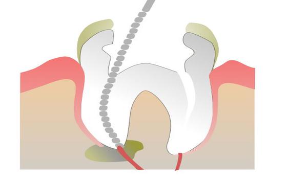 Root Canal Treatment